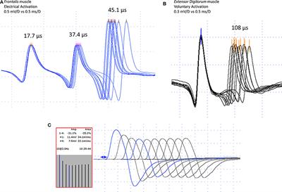 Concentric Needle Jitter in 97 Myasthenia Gravis Patients